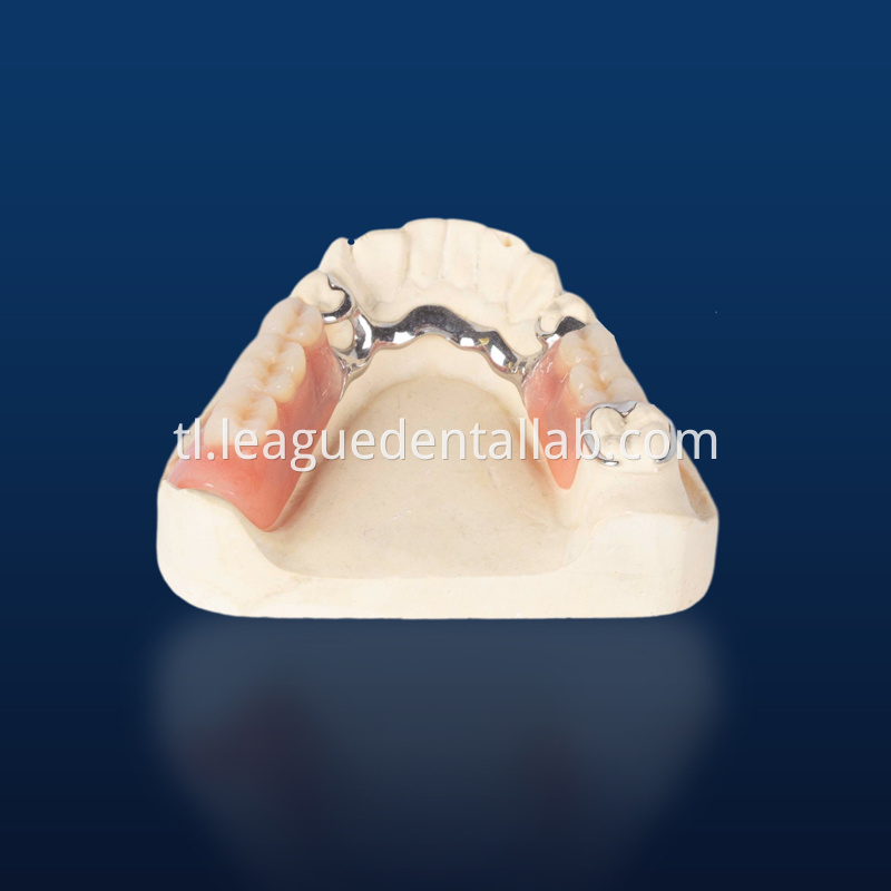 Cast partial,3D printed metal partial,Bego metal partial,cast metal framework,Vatalium Metal framework